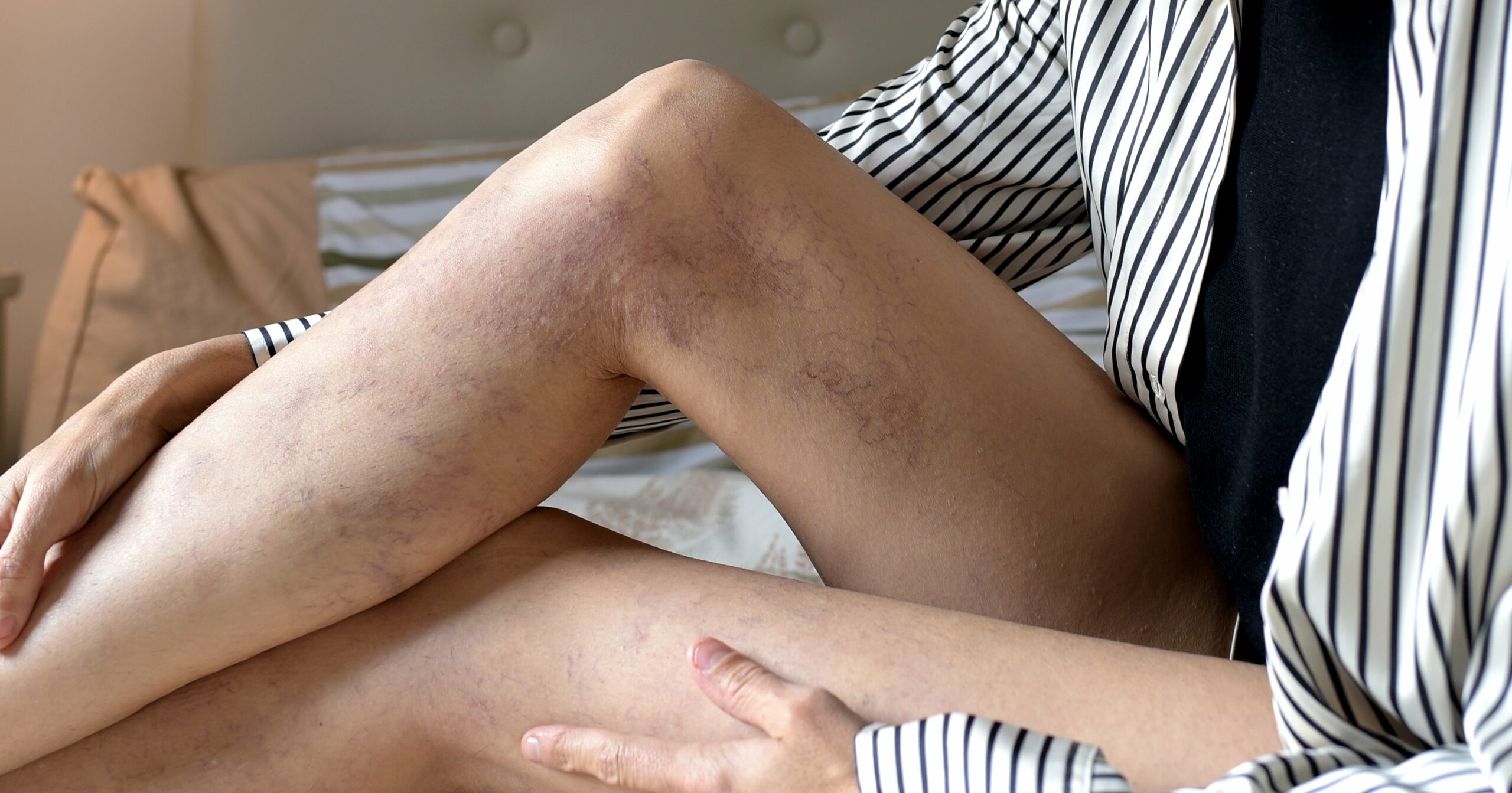 how-to-treat-varicose-veins,-according-to-a-dermatologist