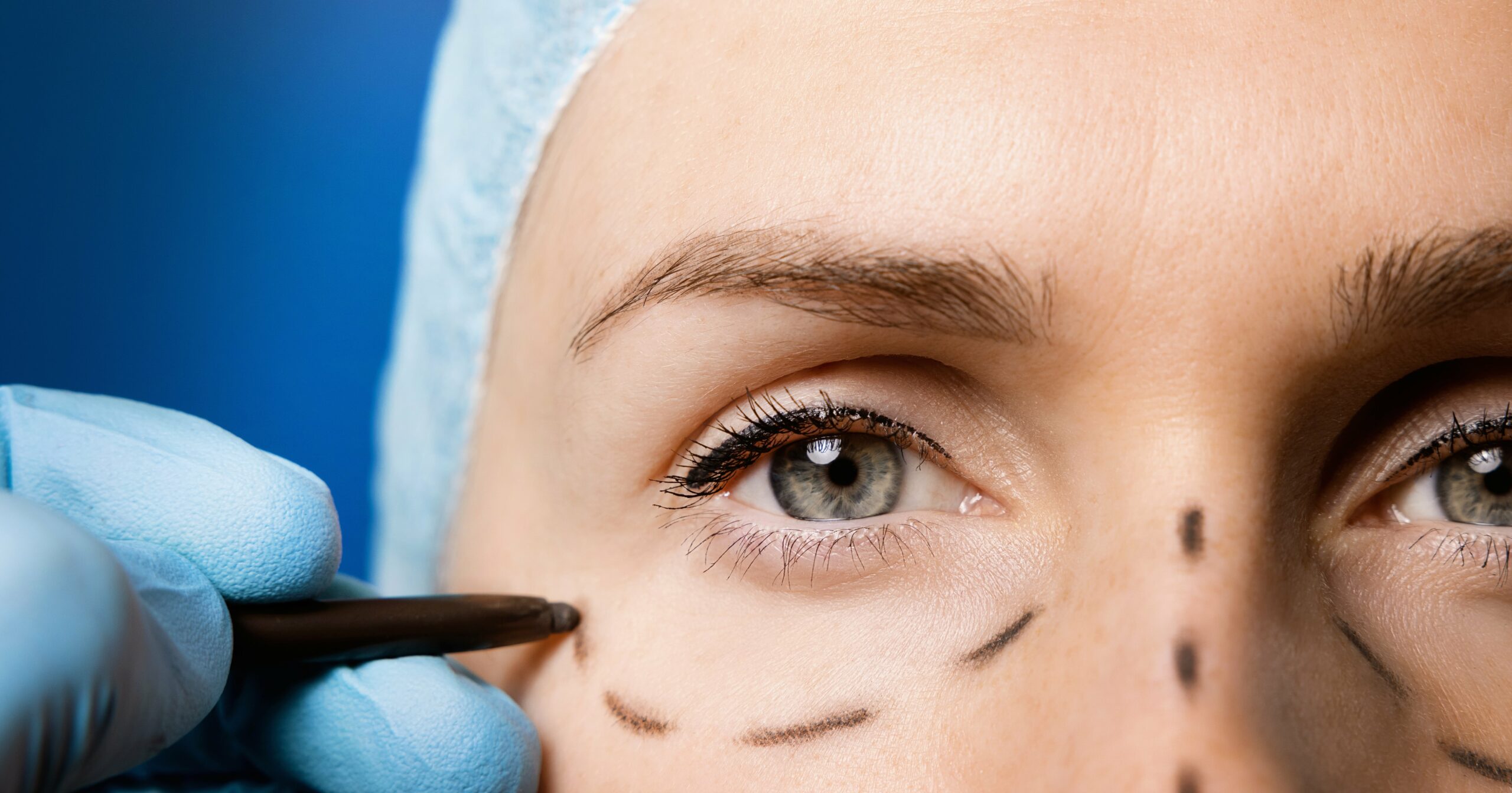 what-is-the-“one-stitch”-facelift?