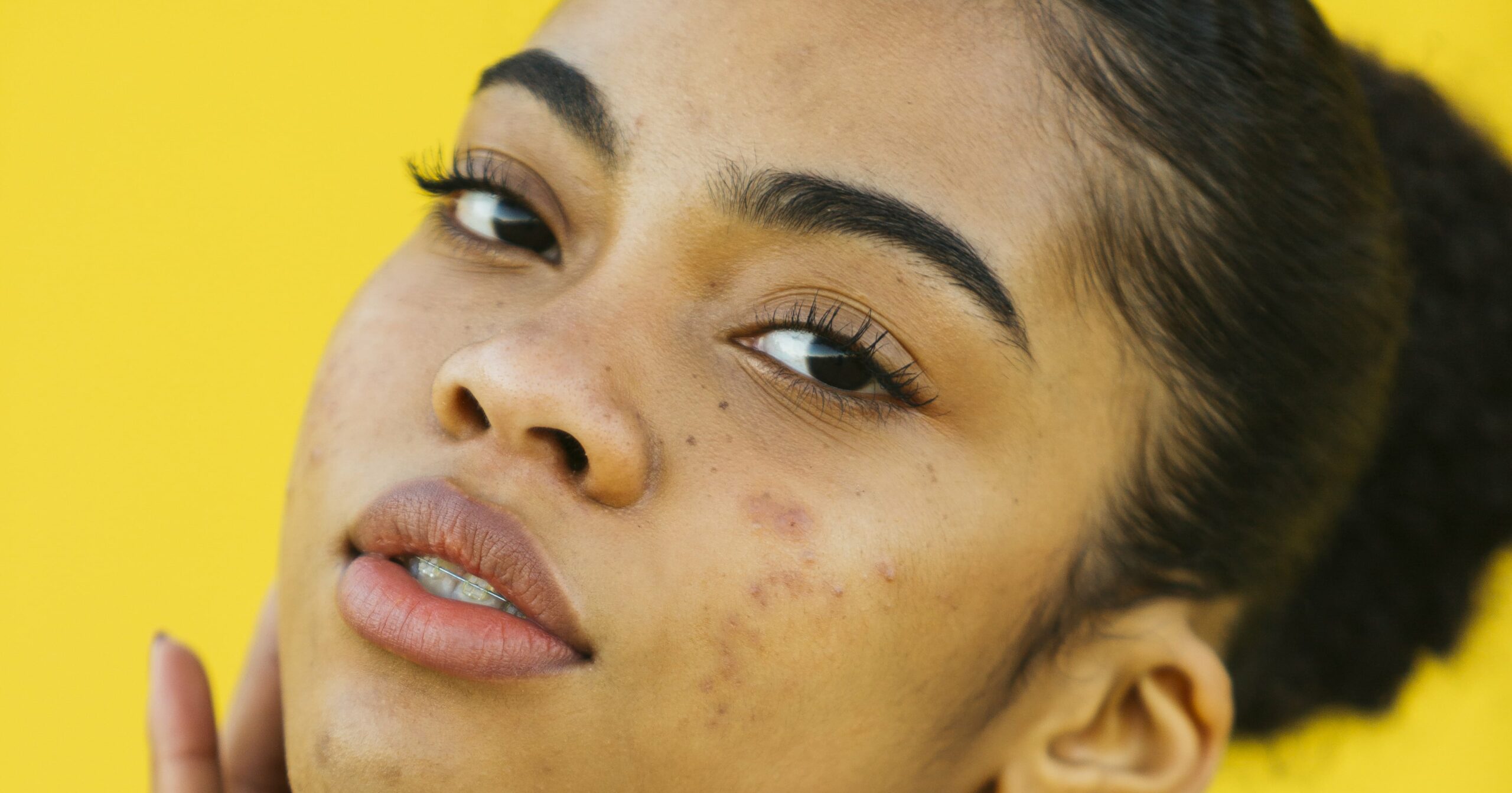 what-type-of-acne-do-i-have?-take-this-quiz-to-find-out