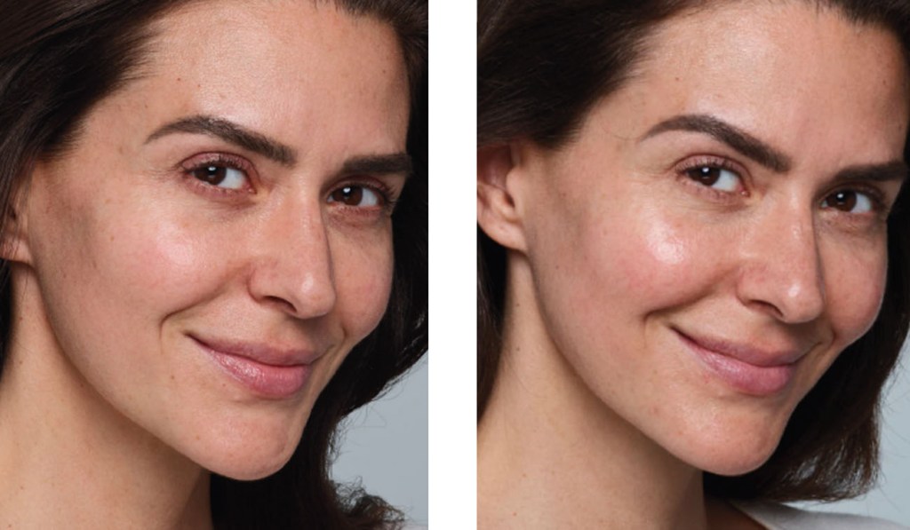 what-is-skinvive-by-juvederm?-the-new-injectable-treatment explained