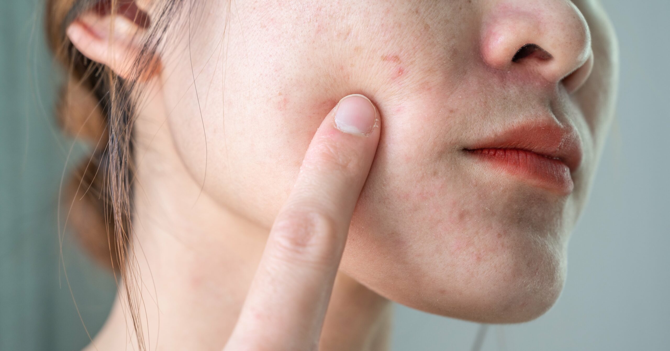 how-to-get-rid-of-those-tiny-broken-capillaries-on-your-face