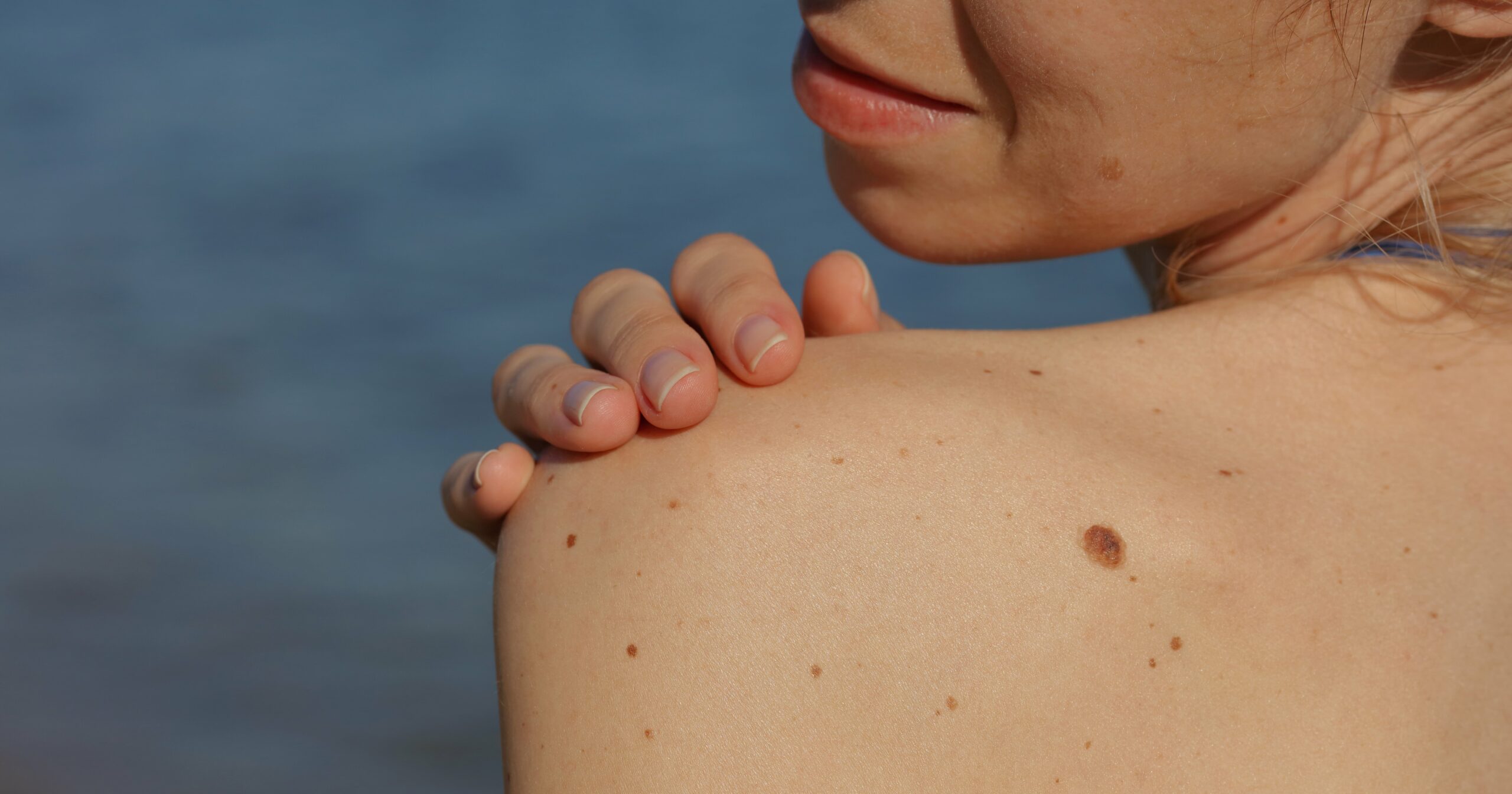 a-guide-to-melanoma:-what-to-look-for,-treatment,-and-more