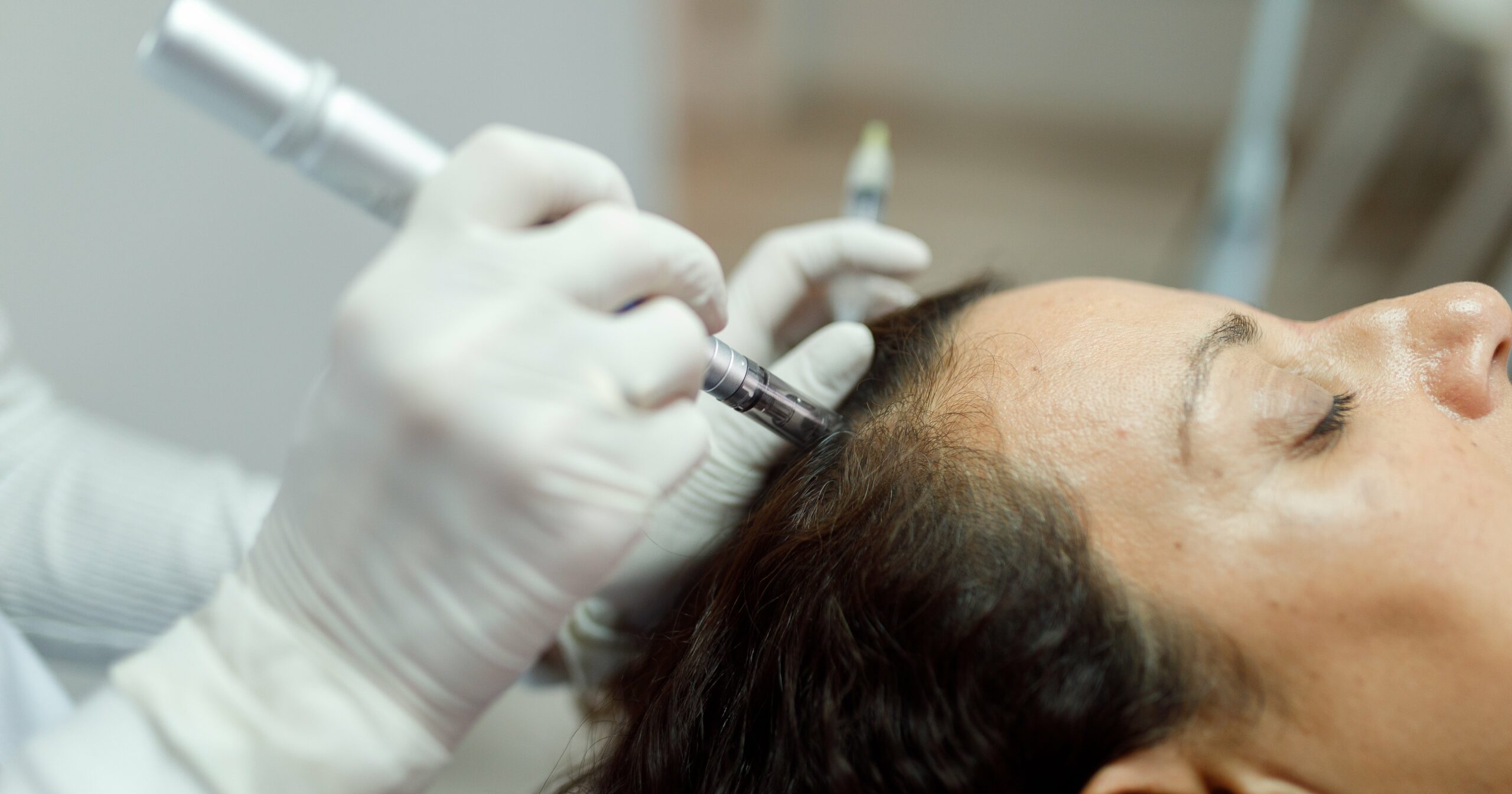 does-microneedling-help-with-hair-loss?-experts-weigh-in