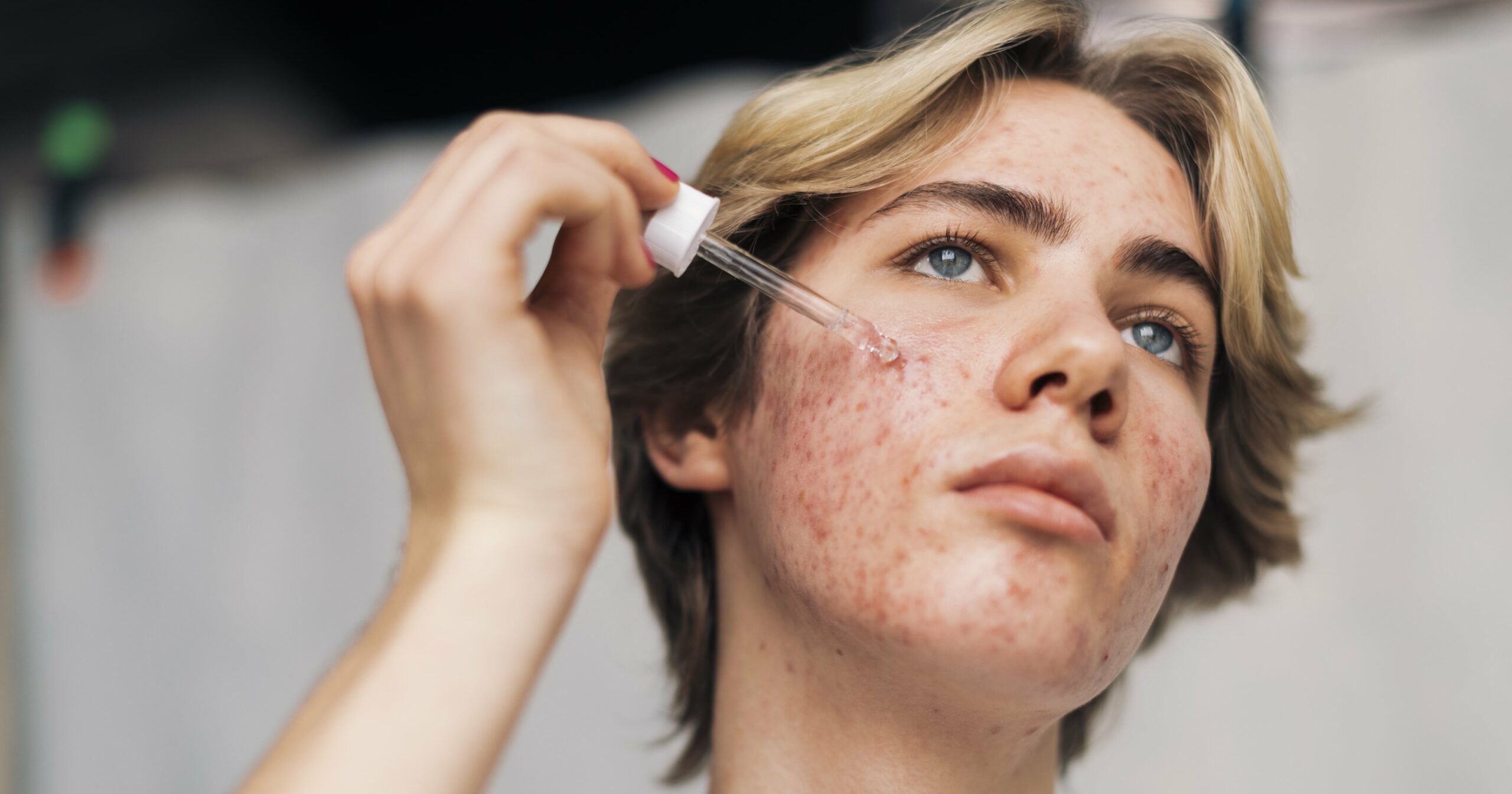 how-to-treat-pimples-under-the-skin-that-won’t-go-away