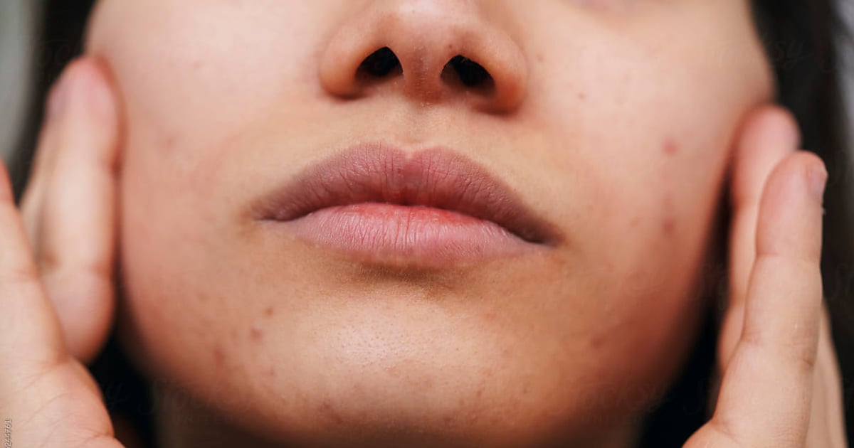 here’s-how-to-remove-blackheads-at-home-safely