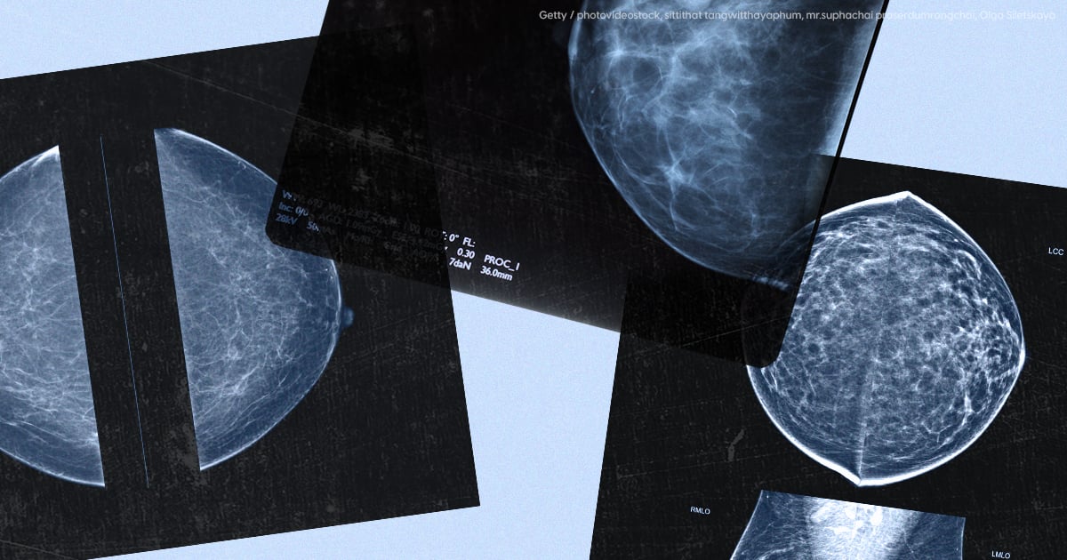 could-ai-help-catch-breast-cancers-that-mammograms-miss?