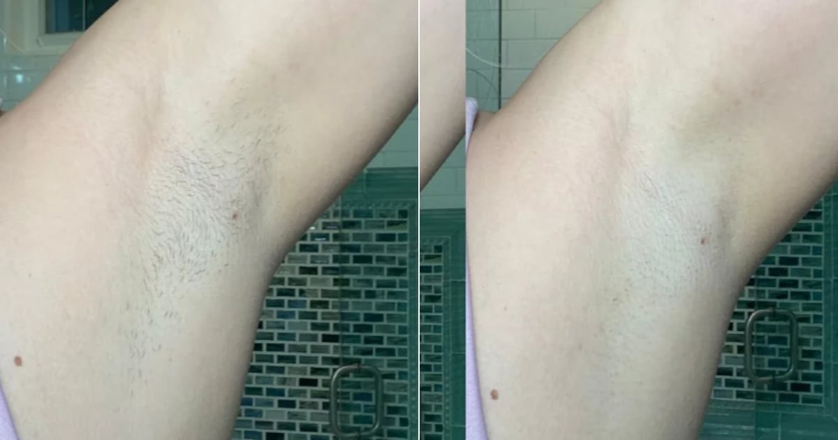 i-tried-ulike’s-at-home-hair-removal-laser