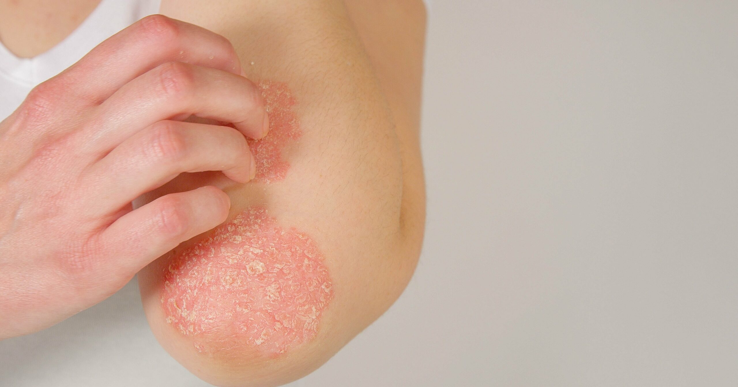 what-is-psoriasis?-dermatologists-break-down-the-skin-condition