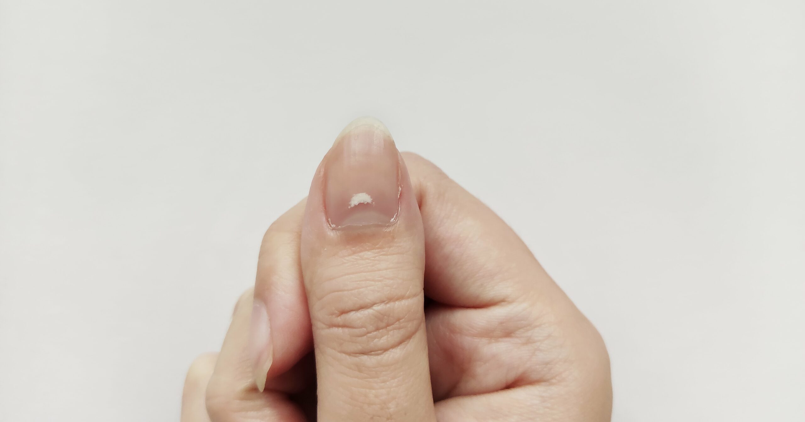 what-are-those-white-spots-on-your-nails?