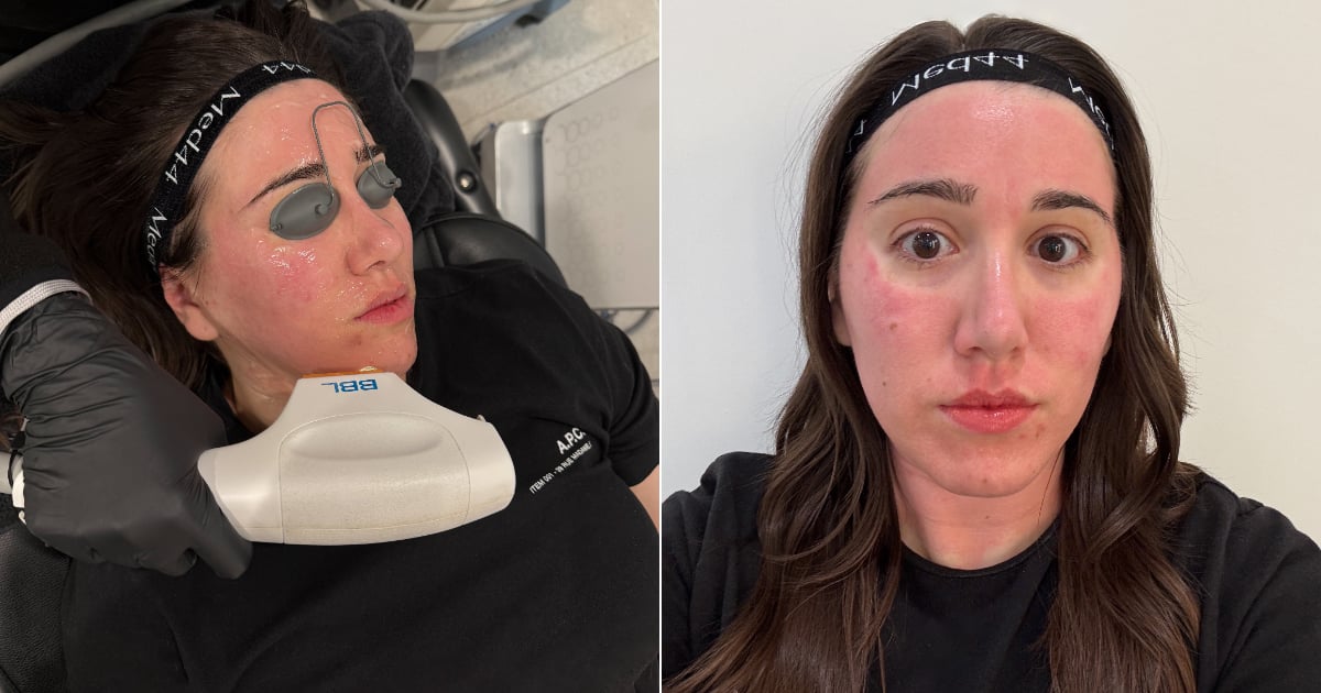 i-tried-“laser-layering”-for-my-dark-spots-and-rosacea