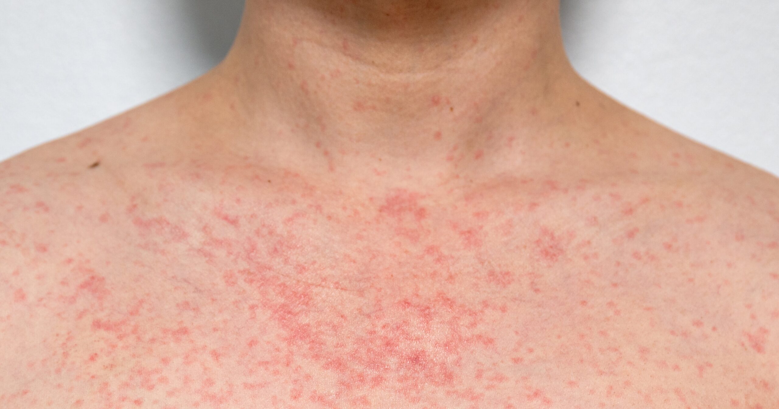 how-to-prevent-(and-treat)-heat-rash,-according-to-experts