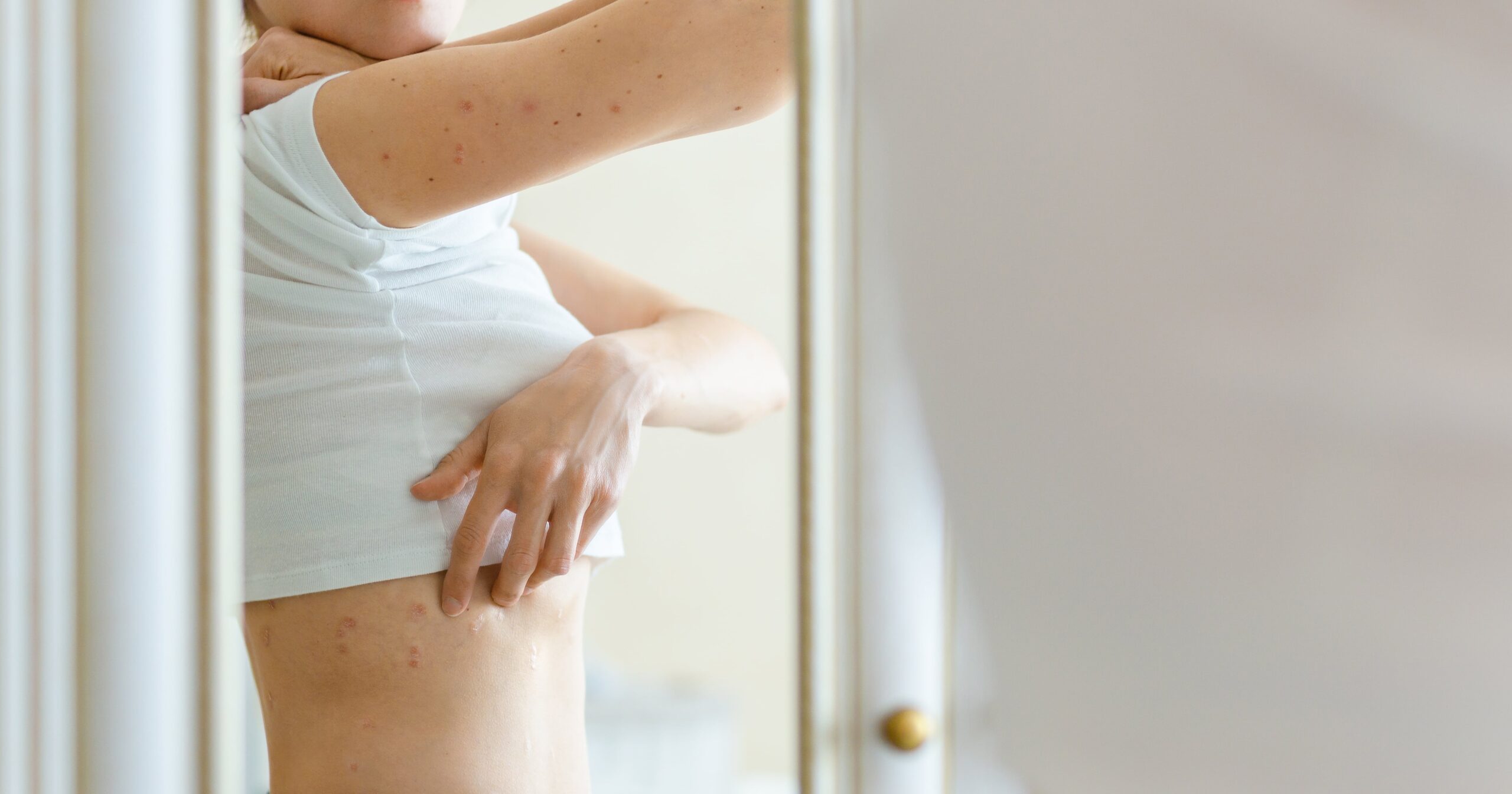 the-surprising-link-between-eczema-and-eating-disorders-–-and-what-to-do