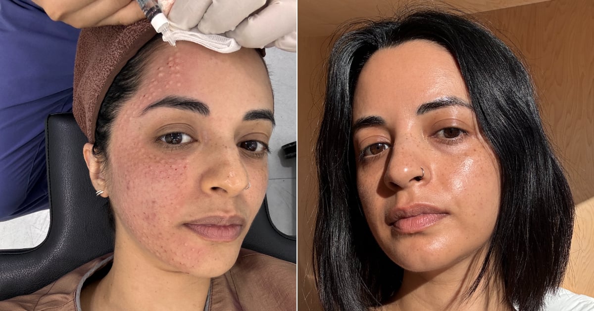 i-tried-the-celebrity-loved-salmon-sperm-facial-–-here’s-my-honest-take