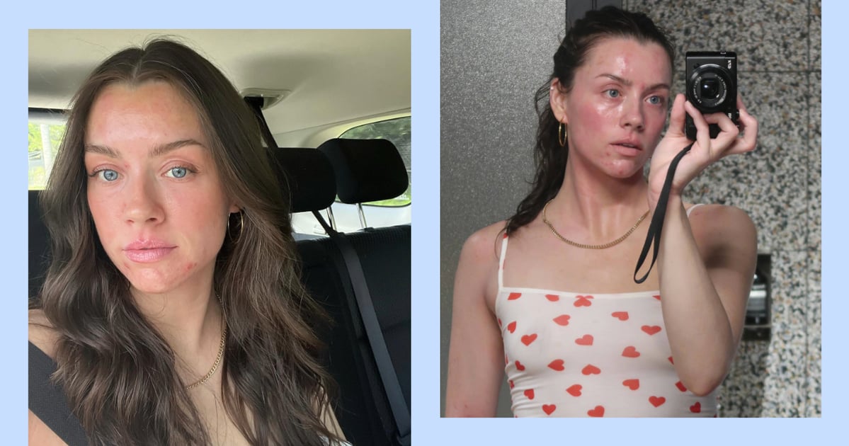 skinfluencer-madeleine-edwards-doesn’t-let-eczema-flare-ups-run-her-life