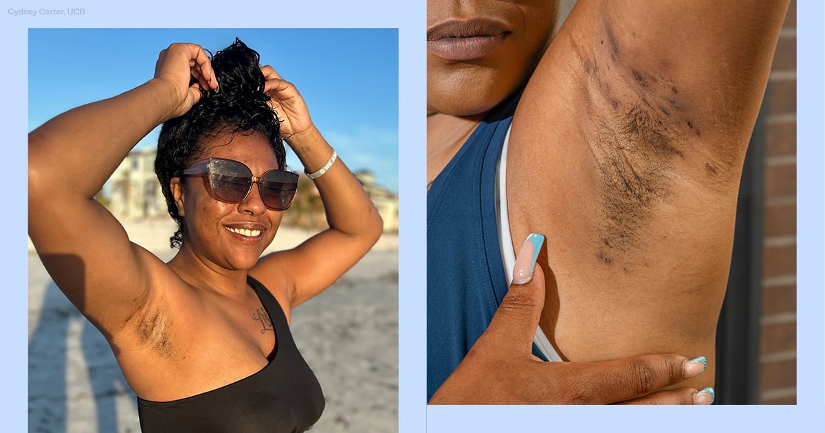 how-i-learned-to-love-my-bumps-and-scars-from-hidradenitis-suppurativa